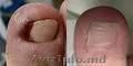  Corectie laser (Tratament laser) a unghiei incarnate    Corectie laser (Tratame